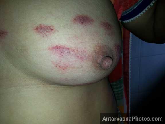 Love Marks Given on Aunt's Breasts